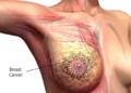 WHO releases training manual to expand access to early breast cancer care