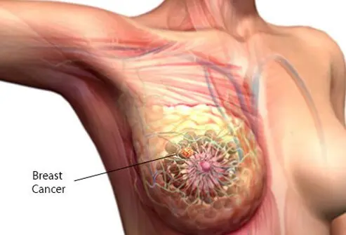 WHO releases training manual to expand access to early breast cancer care